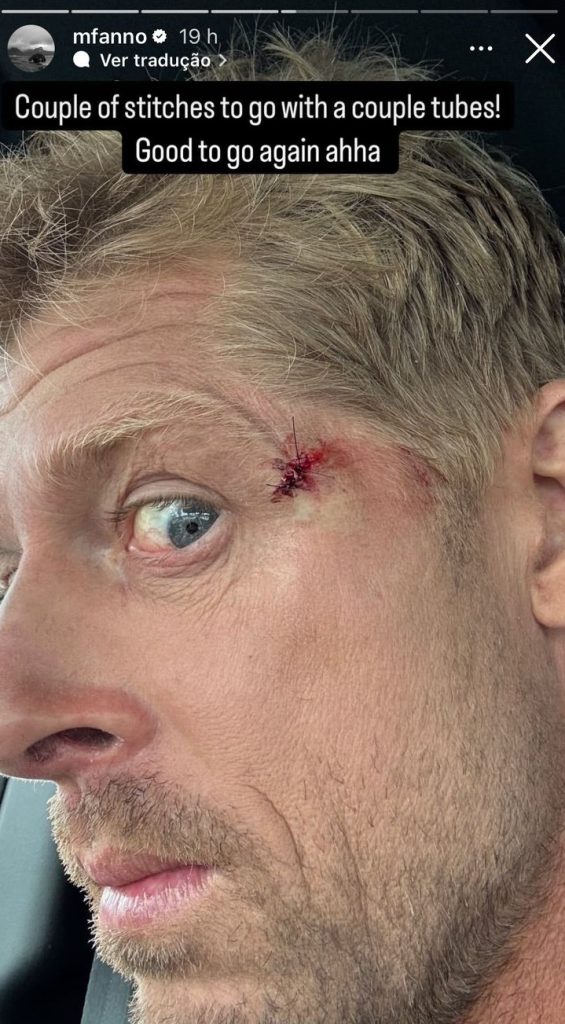 Mick Fanning exibe ferimentos nas redes sociais.
